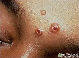 Cryptococcosis