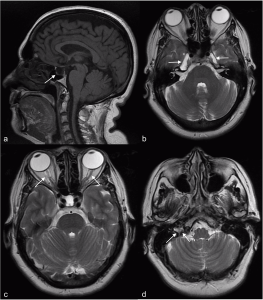 Intracranial Stenosis Stents Market