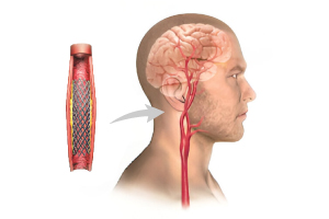 Intracranial Stenosis Stents