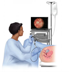 cystoscopy