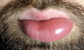 angioedema treatment